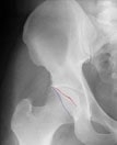 Hip Labral Tears and Femoroacetabular Impingement A Frequent Cause of Non-Arthritic Hip Pa...